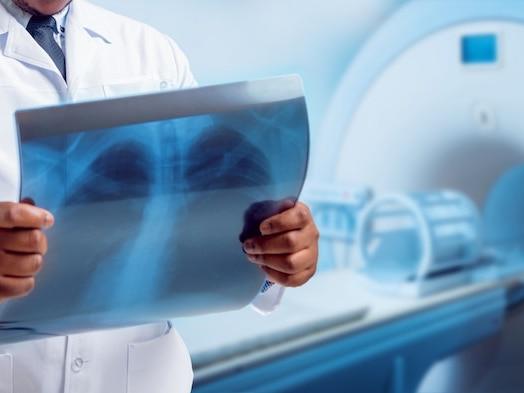 Câncer de pulmão: radioterapia é indicada para o tratamento