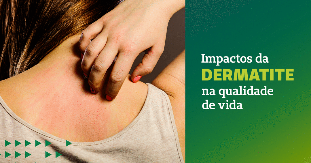 Impactos da dermatite na qualidade de vida