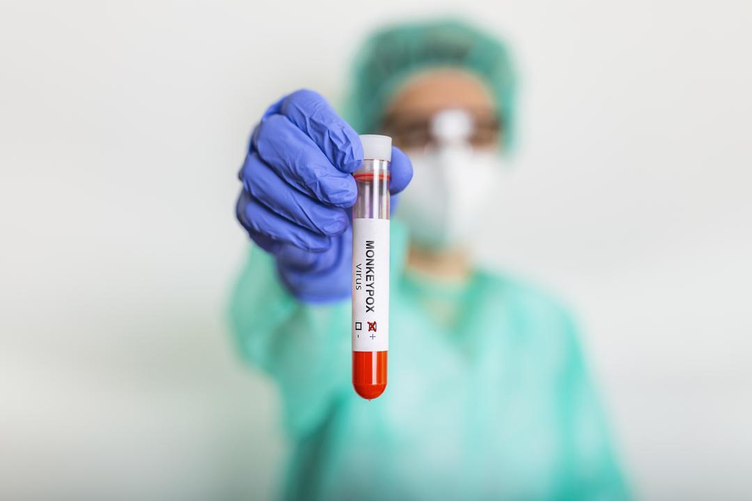 Laboratório passa a disponibilizar testes para diagnóstico da Monkeypox no Paraná e em outros estados do Sul do Brasil